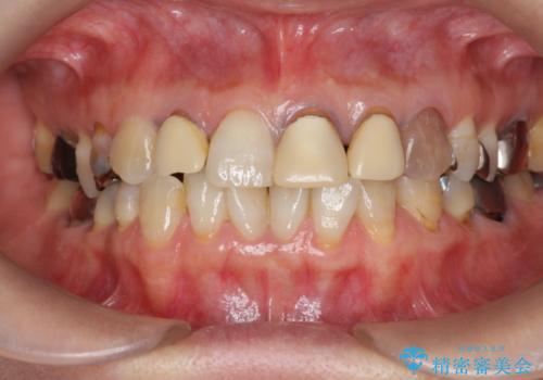 劣化した前歯の差し歯　オールセラミッククラウン審美治療の治療前