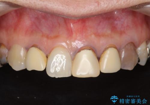 劣化した前歯の差し歯　オールセラミッククラウン審美治療の治療前