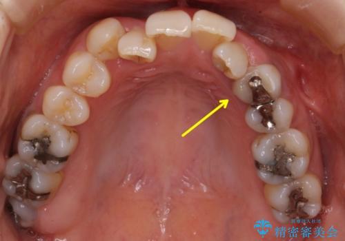 前歯のセラミッククラウン　犬歯に相当する部位に自然にの治療前