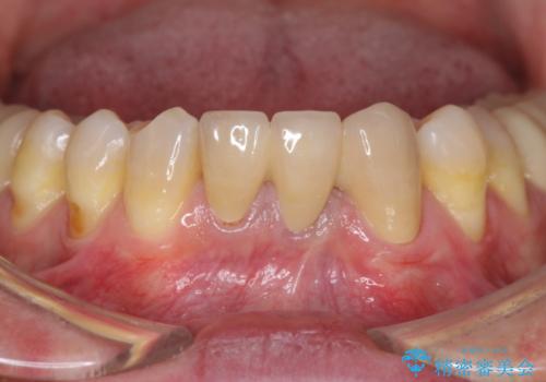 矯正治療を併用した前歯ブリッジの再作製の治療後