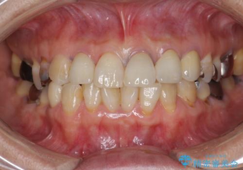 劣化した前歯の差し歯　オールセラミッククラウン審美治療の治療後