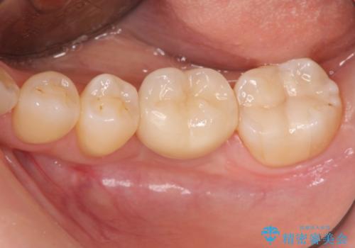 破折による欠損歯　ストローマン社製インプラントによる咬合回復の治療後