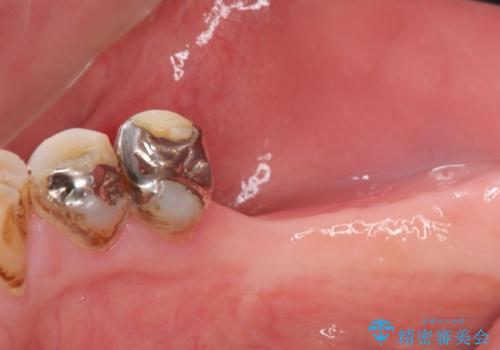 奥歯の喪失  骨造成を伴うインプラント咬合回復の治療前