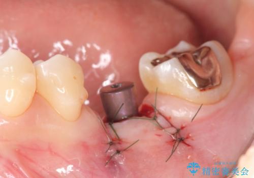 破折による欠損歯　ストローマン社製インプラントによる咬合回復の治療中