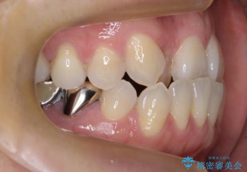 奥歯のブリッジを白く　矯正含めた総合治療で、歯周病、根の問題、一気に解決の治療前