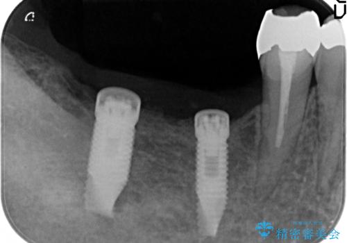 奥歯の喪失  骨造成を伴うインプラント咬合回復の治療中