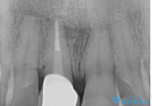 神経の死んだ前歯のレジン修復の劣化　ジルコニアクラウンによる審美回復の治療後