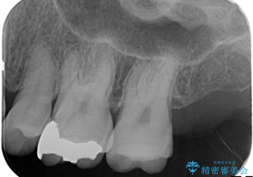 銀歯のやり直し　虫歯治療　セラミックインレーに変更の治療前