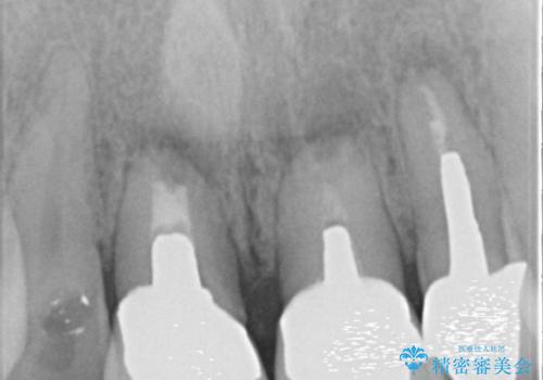 上の前歯を根の治療からの再補綴の治療前