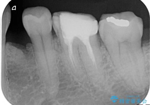 中途半端な継ぎ接ぎの歯を、クラウンでしっかりと処置するの治療前