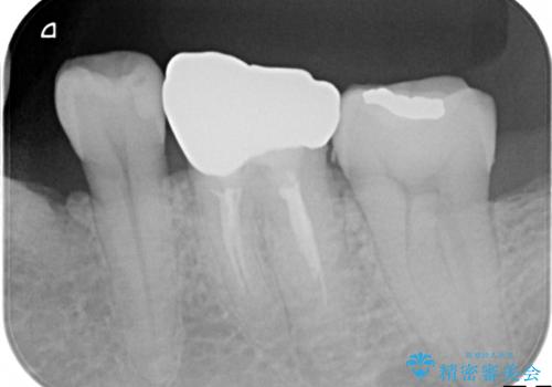 中途半端な継ぎ接ぎの歯を、クラウンでしっかりと処置するの治療後
