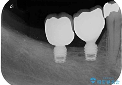 奥歯で咬めない　インプラントによる咬合回復②　歯肉移植・補綴の治療後