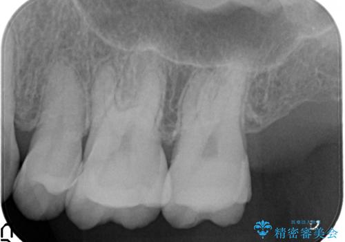 銀歯のやり直し　虫歯治療　セラミックインレーに変更の治療後