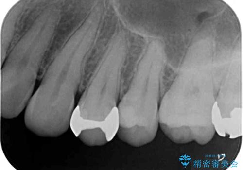 歯の内部が黒く変色し痛む　大きな虫歯のセラミックインレー治療の治療後