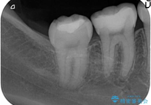 銀歯を目立たなくする　セラミック治療　の治療後