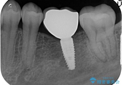 破折による欠損歯　ストローマン社製インプラントによる咬合回復