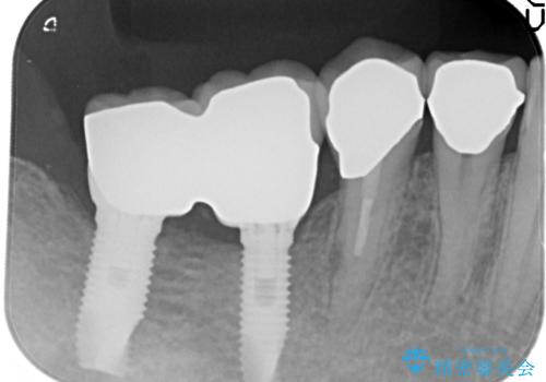 奥歯の喪失  骨造成を伴うインプラント咬合回復