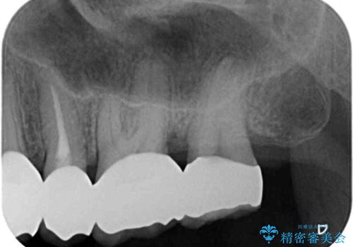 歯肉の中の深い虫歯　外科処置による適正な虫歯治療の治療後