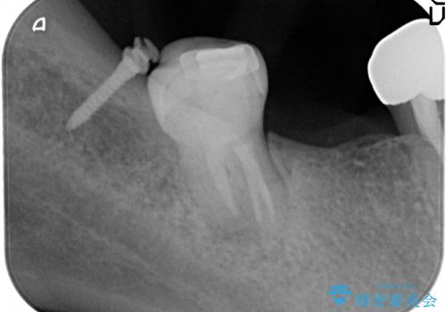 奥歯のブリッジを白く　矯正含めた総合治療で、歯周病、根の問題、一気に解決の治療中