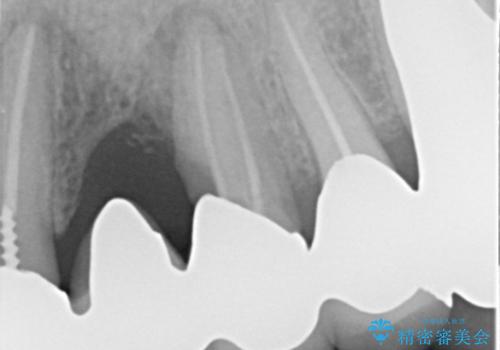 [重度の骨吸収] 顎骨の再建を伴うインプラント治療の治療前