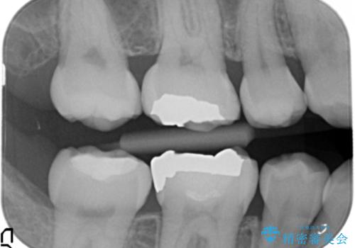 銀歯を目立たなくする　セラミック治療　の治療前