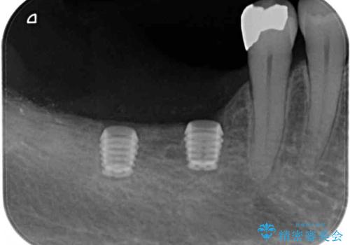 奥歯で咬めない　インプラントによる咬合回復①　骨造成　の治療後