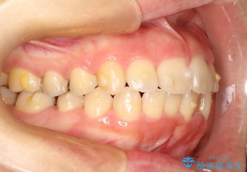 インビザラインinvisalignによる軽度ガタつきの歯列矯正治療の治療中