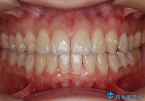 前歯の部分矯正　インビザラインエクスプレスパッケージの治療中