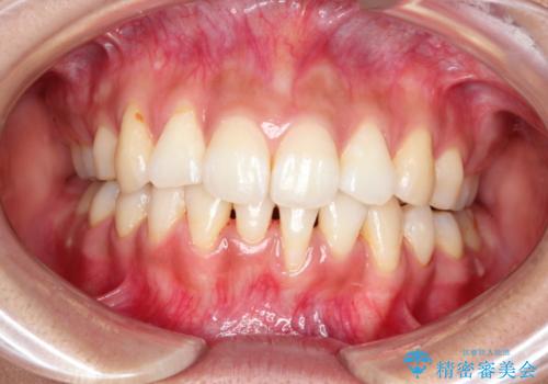 目立たない装置で前歯のデコボコを改善　リンガル装置の抜歯矯正