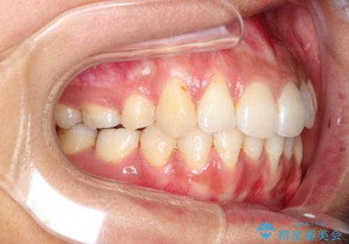 目立たない装置で前歯のデコボコを改善　リンガル装置の抜歯矯正の治療後