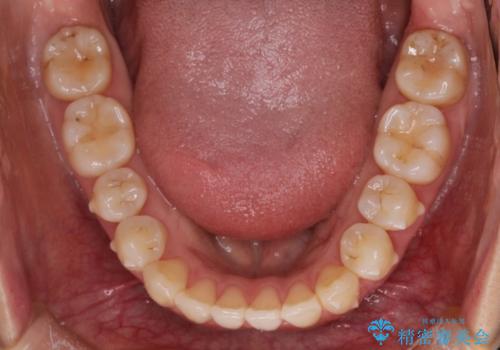 前歯の部分矯正　インビザラインエクスプレスパッケージの治療中