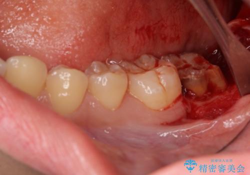 銀歯がすぐとれる　短い歯を長くするの治療前