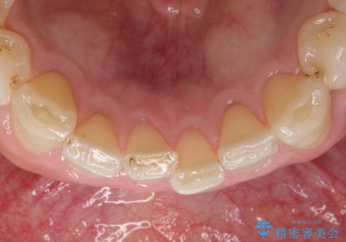オールセラミッククラウン　上顎前歯部の隙間をセラミック矯正での治療前