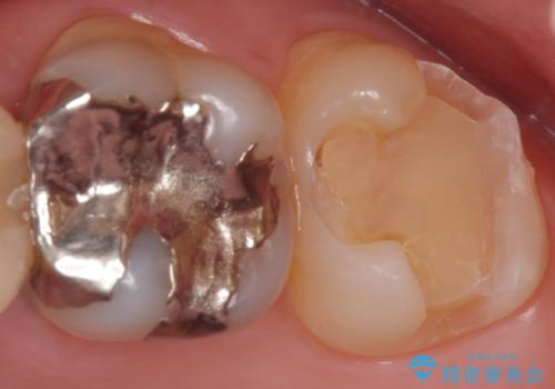 PGA(ゴールド)インレー　虫歯治療の治療中