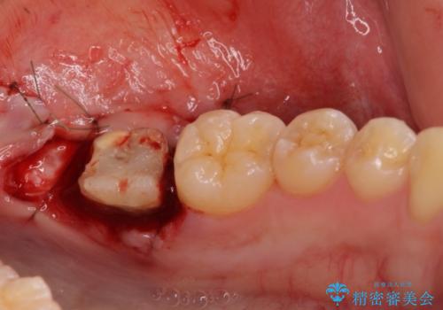 銀歯がすぐとれる　短い歯を長くするの治療中