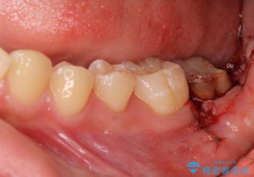 銀歯がすぐとれる　短い歯を長くするの治療中