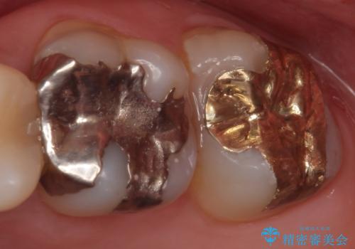 PGA(ゴールド)インレー　虫歯治療