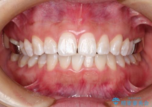 矯正中にPMTCとホワイトニングで歯を白くの症例 治療後