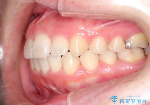 インビザラインinvisalignによる軽度ガタつきの歯列矯正治療の治療後