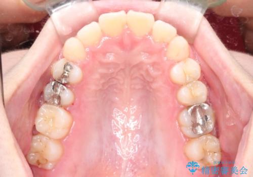 インビザラインinvisalignによる軽度ガタつきの歯列矯正治療の治療後