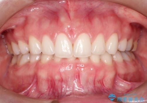 単純歯肉切除による歯のライン改善の治療後