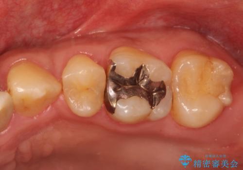 銀歯のやり直し　虫歯治療　セラミックインレーに変更の症例 治療前