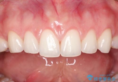 単純歯肉切除による歯のライン改善の症例 治療後