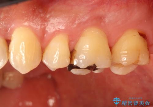 銀歯のやり直し　虫歯治療　セラミックインレーに変更の治療前