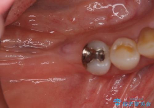 奥歯で咬めない　インプラントによる咬合回復②　歯肉移植・補綴の治療前