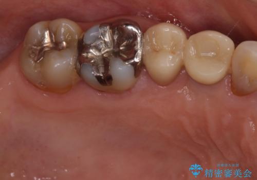 奥歯で咬めない　インプラントによる咬合回復②　歯肉移植・補綴の治療中