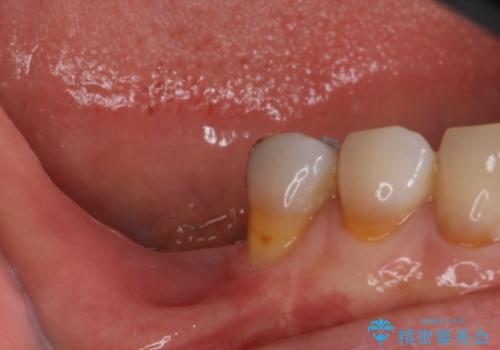 奥歯で咬めない　インプラントによる咬合回復②　歯肉移植・補綴の症例 治療前