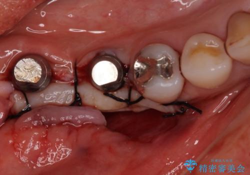 奥歯で咬めない　インプラントによる咬合回復②　歯肉移植・補綴の治療中