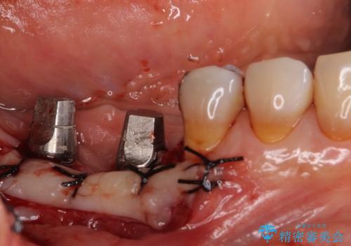 奥歯で咬めない　インプラントによる咬合回復②　歯肉移植・補綴