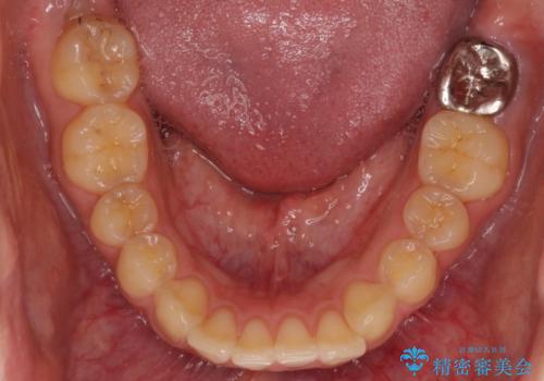 銀歯がすぐとれる　短い歯を長くするの治療前